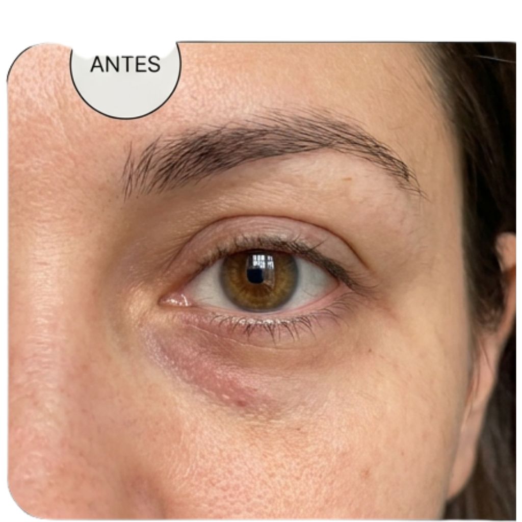Antes